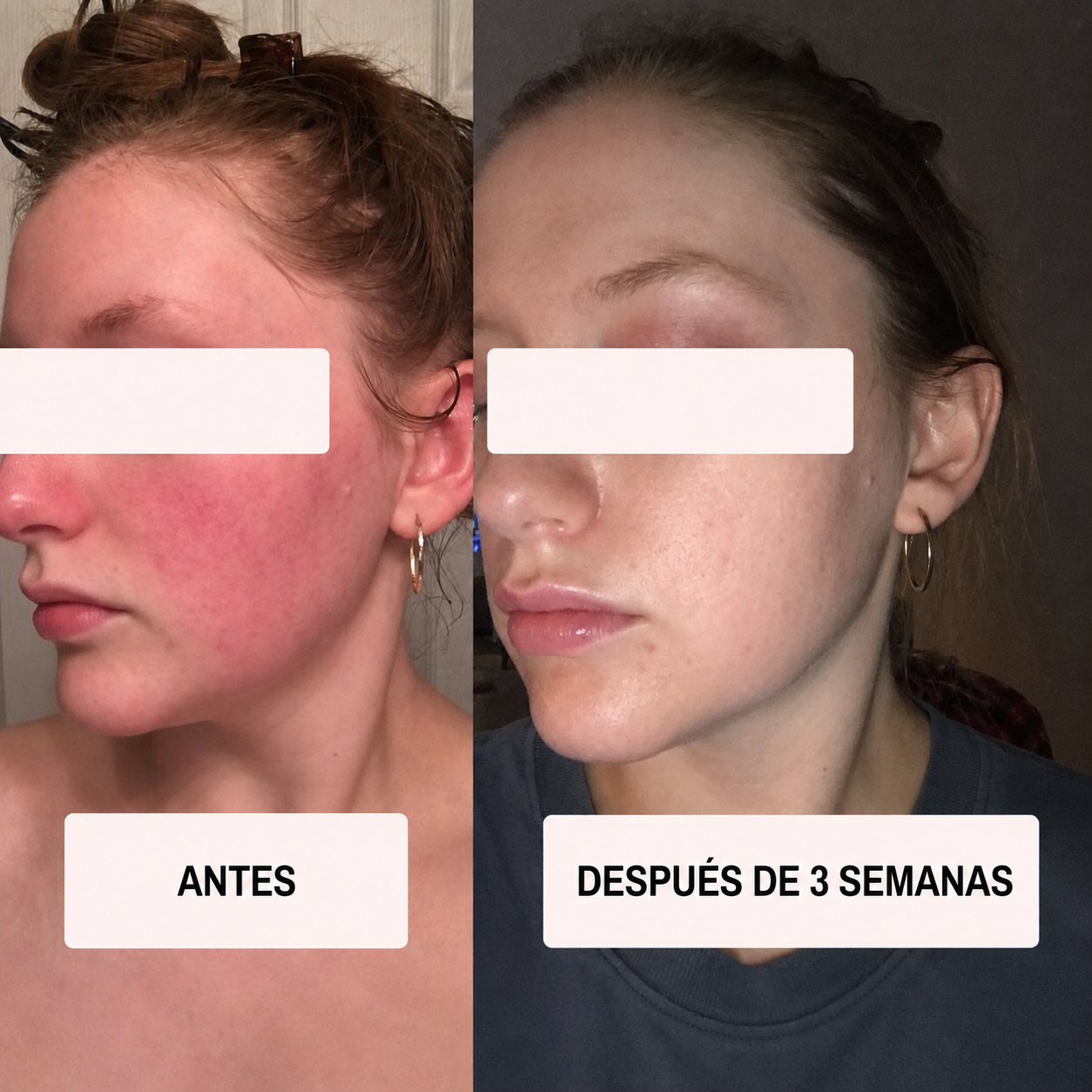 Máscara LED y Microcorriente para Lifting Facial sin Cirugía - Atlas Lab Nova™